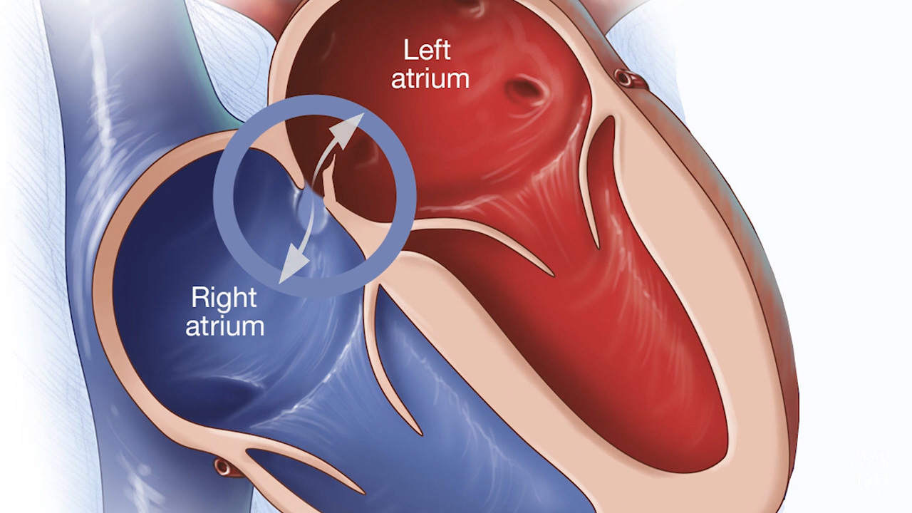 Le Foramen Ovale AVGPlongee   Patent Foramen Ovale 16x9 1 